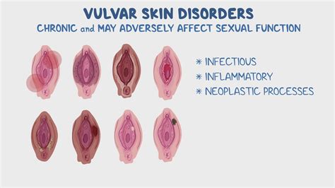 The Dilemma of Extra Skin in Vagina: Causes, Symptoms, and Treatment Options