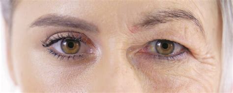 Unlocking the Secret to Rejuvenating Your Gaze: The Lowdown on Extra Skin on Eyelids