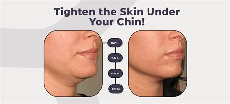 Banish Your Double Chin and Reclaim Your Confidence with These Tips for Reducing Extra Submental Skin