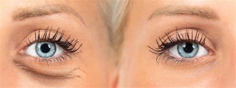 Say Goodbye to Extra Skin Under Eyes with these Tips