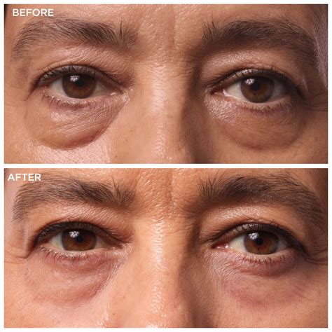 Eye Bags & Dark Circles: Quick Fixes