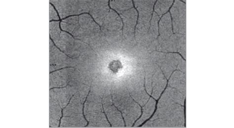 Eye damage from solar eclipse