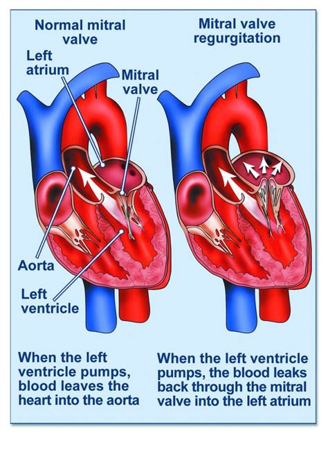 FAQs Mitral Regurgitation