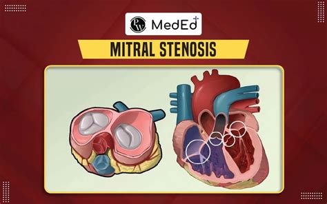 FAQs Mitral Stenosis