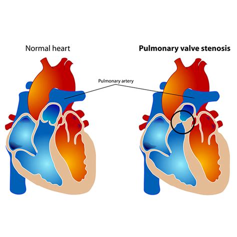 FAQs Pulmonary Stenosis