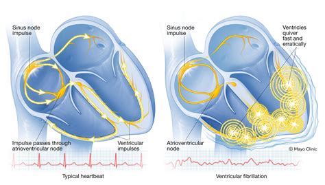 Ventricular Fibrillation