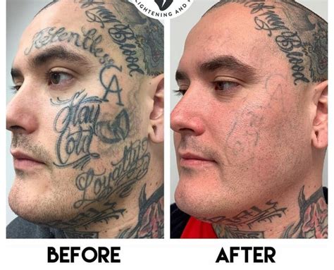 Face Tattoo Removal before and after one treatment YouTube