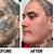 Face Tattoo Removal Before And After