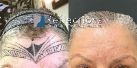 Face Tattoos Removed