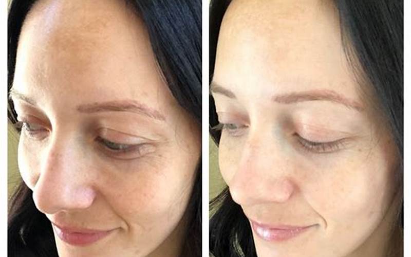 Facial Peel Before And After