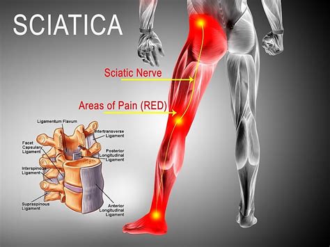 Factors Affecting the Length of Time for Sciatica Relief