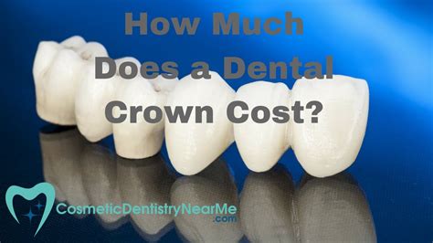 Factors That Affect the Cost of a Crown Tooth
