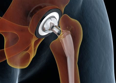 Factors that Affect the Cost of Hip Replacement Surgery
