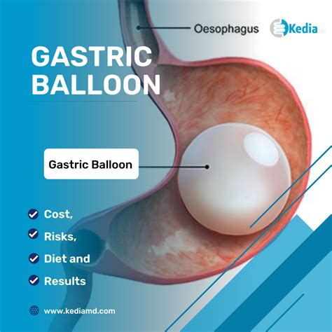 Factors that Affect the Cost of the Gastric Balloon Procedure