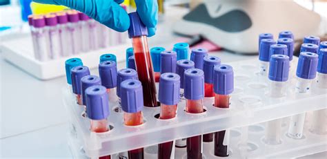 Factors to Consider When Choosing a Private Blood Test Lab