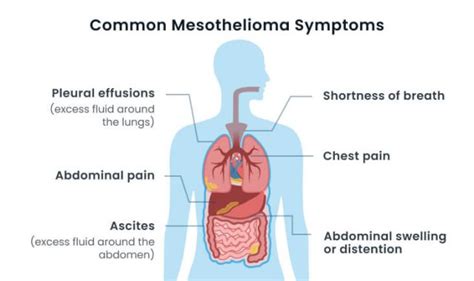 Factors Influencing Mesothelioma Development Time