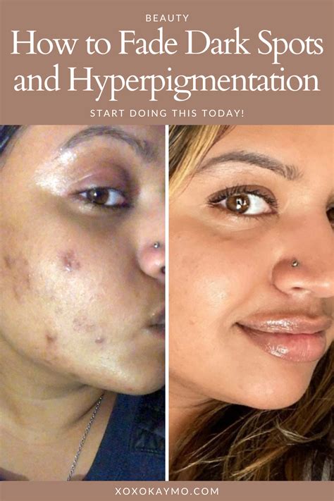 Fading Dark Spots and Hyperpigmentation
