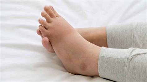 Faktor risiko yang dapat menyebabkan kaki bengkak setelah melahirkan