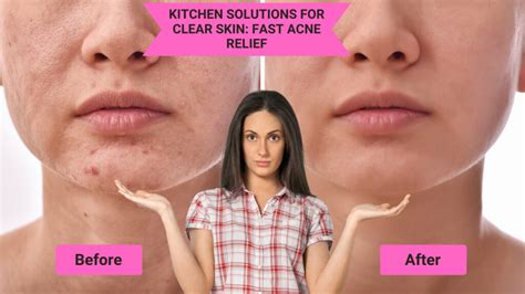 Fast Acne Relief: 6 Natural Solutions