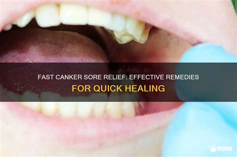 Fast Canker Sore Relief: Tips & Treatments
