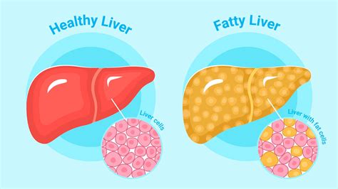 Fatty Liver