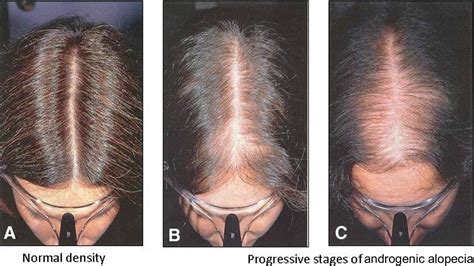 Female-Pattern Baldness