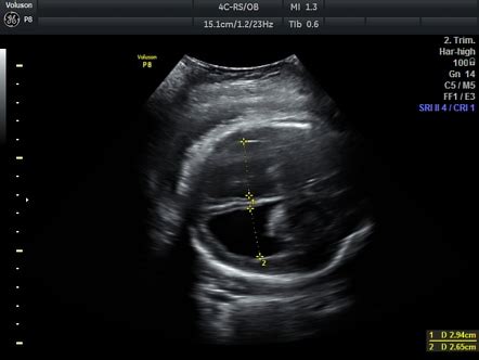 Hydrocephalus Ultrasound