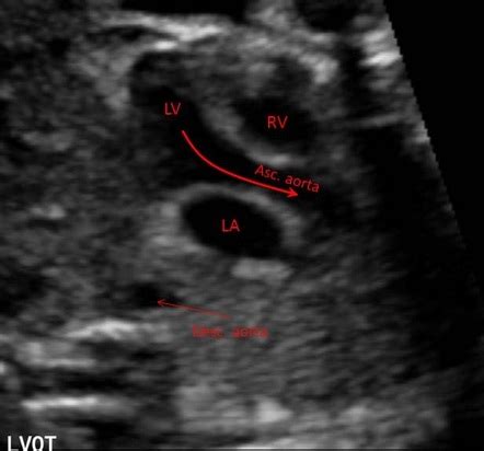 Outflow Tracts Ultrasound
