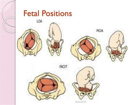 Fetal Positions: Optimize for Healthy Development