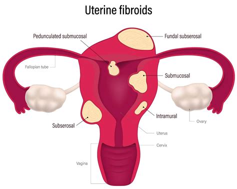 Fibroids & Pregnancy: Risks, Symptoms, and Solutions.