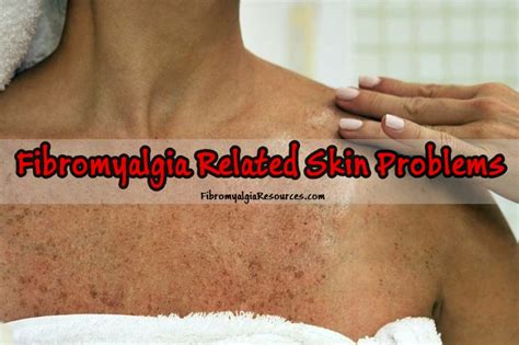 Fighting Fibromyalgia: A Comprehensive Guide to Dealing with Pesky Skin Issues