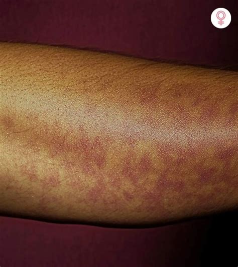 Unveiling the Mysterious Skin Symptoms of Fibromyalgia: Stunning Pictures of Mottled Skin Revealed