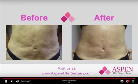 Reviving Radiance: How to Combat Fibrotic Skin After Liposuction