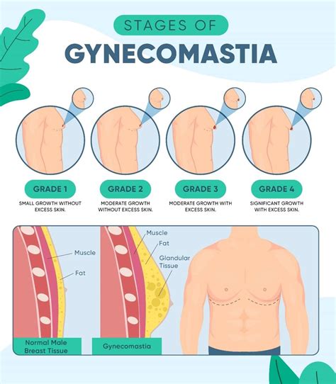 Finasteride Gynecomastia: Essential Knowledge for Men