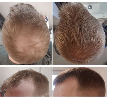 Resultados de Finasteride