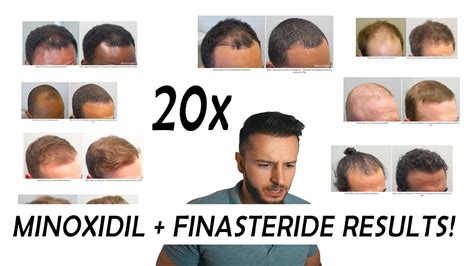 Kombinationsbild von Finasterid und Minoxidil
