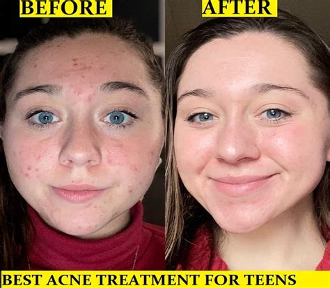 The 17 Best Cystic Acne Treatments in 2021 Acne treatment, Cystic