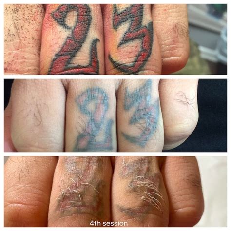 Laser Tattoo Removal Finger tattoos are typically