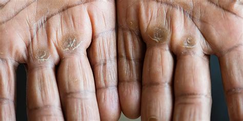 Finger Corns: Causes & Fast Removal Tips