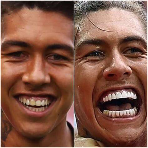 Firmino Teeth Before And After