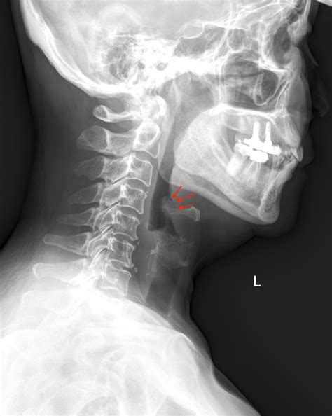 Fishbone Stuck in Throat