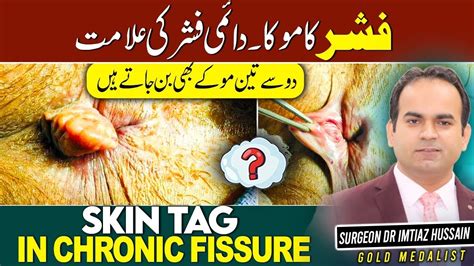 Fascinating Facts About Fissures Accompanied by Skin Tags You Need To Know