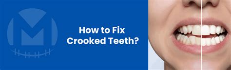 Fix Crooked Teeth: Options & Solutions