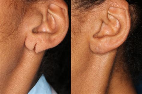 Fix Split Earlobes: Surgery & Recovery Options