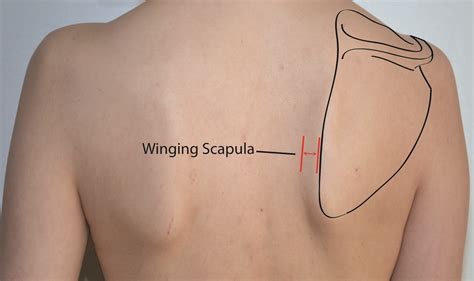 Fix Winged Scapula: Causes & Effective Treatments
