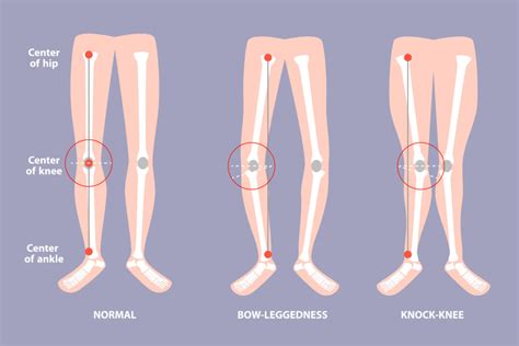 Fix X-Legs: Causes & Effective Treatments