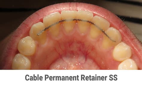 Fixed (Permanent) Retainers