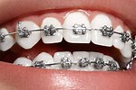 Fixed Appliances Orthodontics Lecture