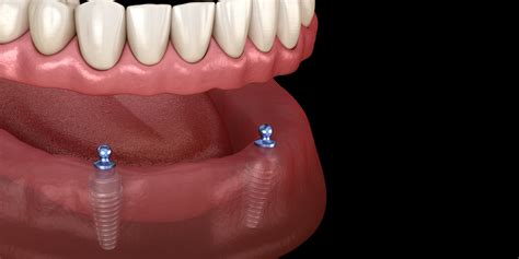 Fixing Dentures in Plano, TX
