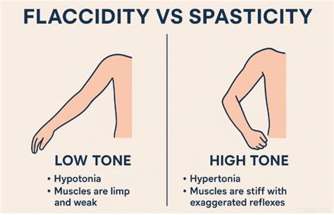 Flaccidity Vs Spasticity